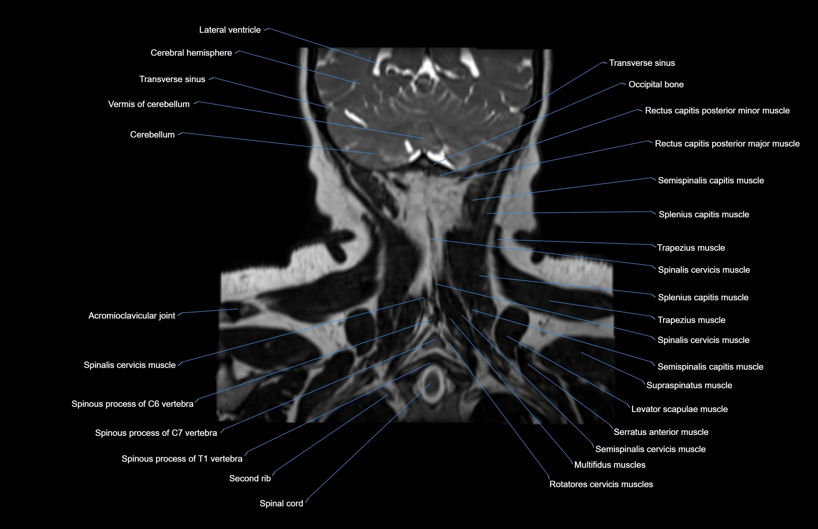 Neck coronal cross sectional MRI anatomy 3T MRI  image-img-00001-00011.webp
